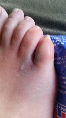 Chiropractic Kingston WA Healing Foot Close Up